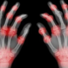 Arthritis in the hand