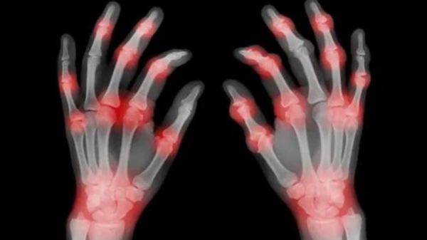 Arthritis in the hand